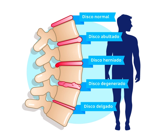 Enfermedad Degenerativa de Disco